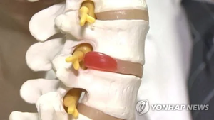 목 디스크 수술했는데…엑스레이 안보고 퇴근한 의사, 환자는 사망
