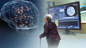 [이미선의 헬스테크] 알츠하이머 치료제 개발 어디까지 왔나…“치매, 더는 사형선고 아냐” 빌게이츠 말 현실될까