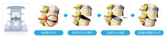 인공디스크. 강남베드로병원 제공