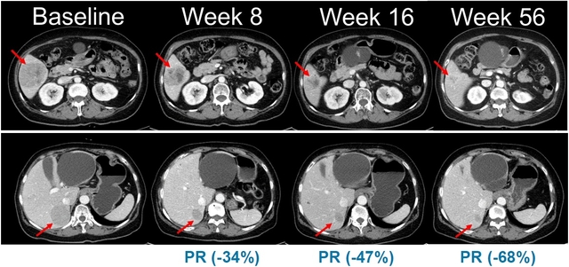 벨바라페닙과 코비메티닙 병용요법 임상시험에서 시간 경과에 따른 병변 변화가 관찰된 복부 CT 영상. 한미약품 제공