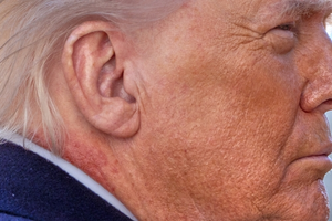 79세 트럼프 목에 선명한 ‘붉은 반점’…백악관 “치료용 연고 때문”