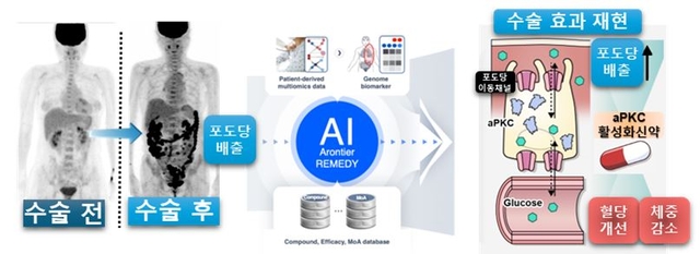 비만대사수술 후 혈당 개선의 주요 기전으로 제시된 장내 포도당 배출현상을 기반으로, AI 기반 신약개발 플랫폼을 통해 핵심 분자 기전인 aPKC/GLUT1 신호축 및 해당 기전을 조절할 수 있는 약물 후보를 도출했다. 세브란스 병원 제공