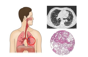 평균 생존기간 3년… K-제약바이오, 특발성 폐섬유증 임상 확대
