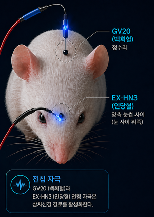 “정수리와 이마에 침 치료했더니”…PTSD 우울·불안 증상 개선