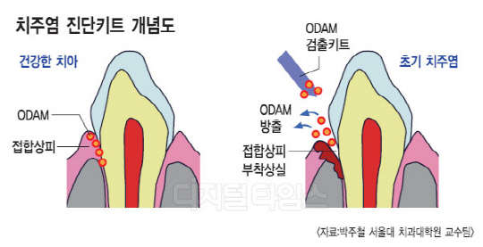 침 속 `ODAM 농도`로 치주질환 진단… 염증 조기 치료로 치조골 파괴 예방도